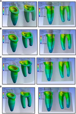 Comparative Evaluation of Stress Acting on Abutment, Bone, and Connector of Different Designs of Acid-Etched Resin-Bonded Fixed Partial Dentures: Finite Element Analysis